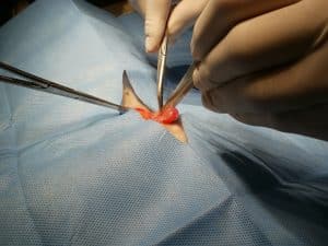 Surgery of abdominal hernia
